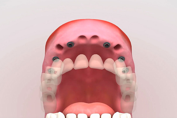 Tratamientos - Implantes - Clínica Dental Dr Luis Ojeda - Vecindario, Gran Canaria